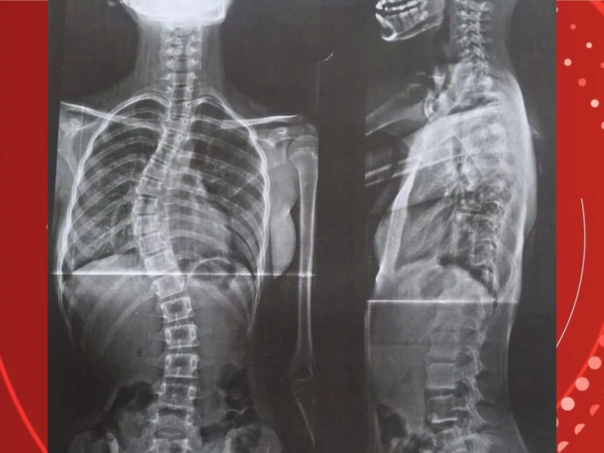 Justiça garante cirurgia de menina com escoliose em Porto Velho