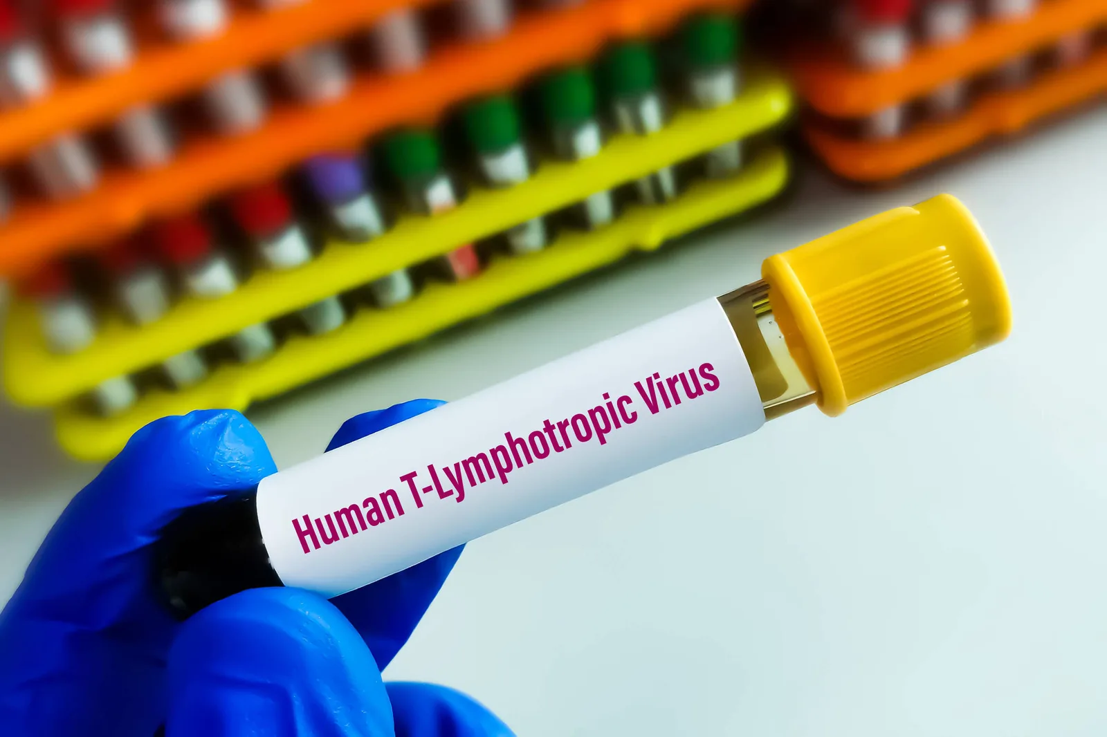 Estudo do Emílio Ribas identifica quadro inflamatório intermediário ligado ao HTLV-1