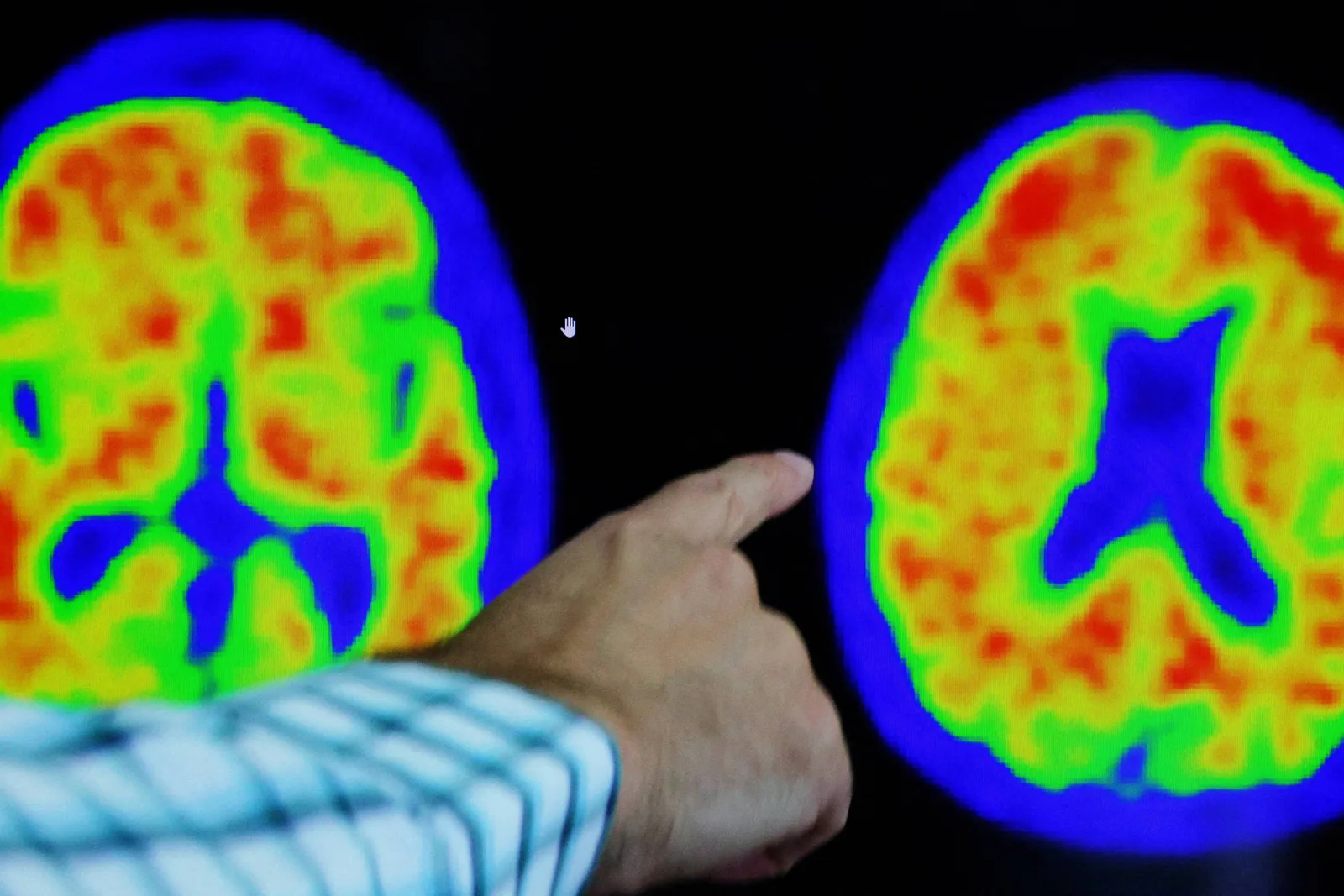 Diagnóstico de Alzheimer ganha biomarcador sanguíneo, mas indicação segue restrita a sintomáticos