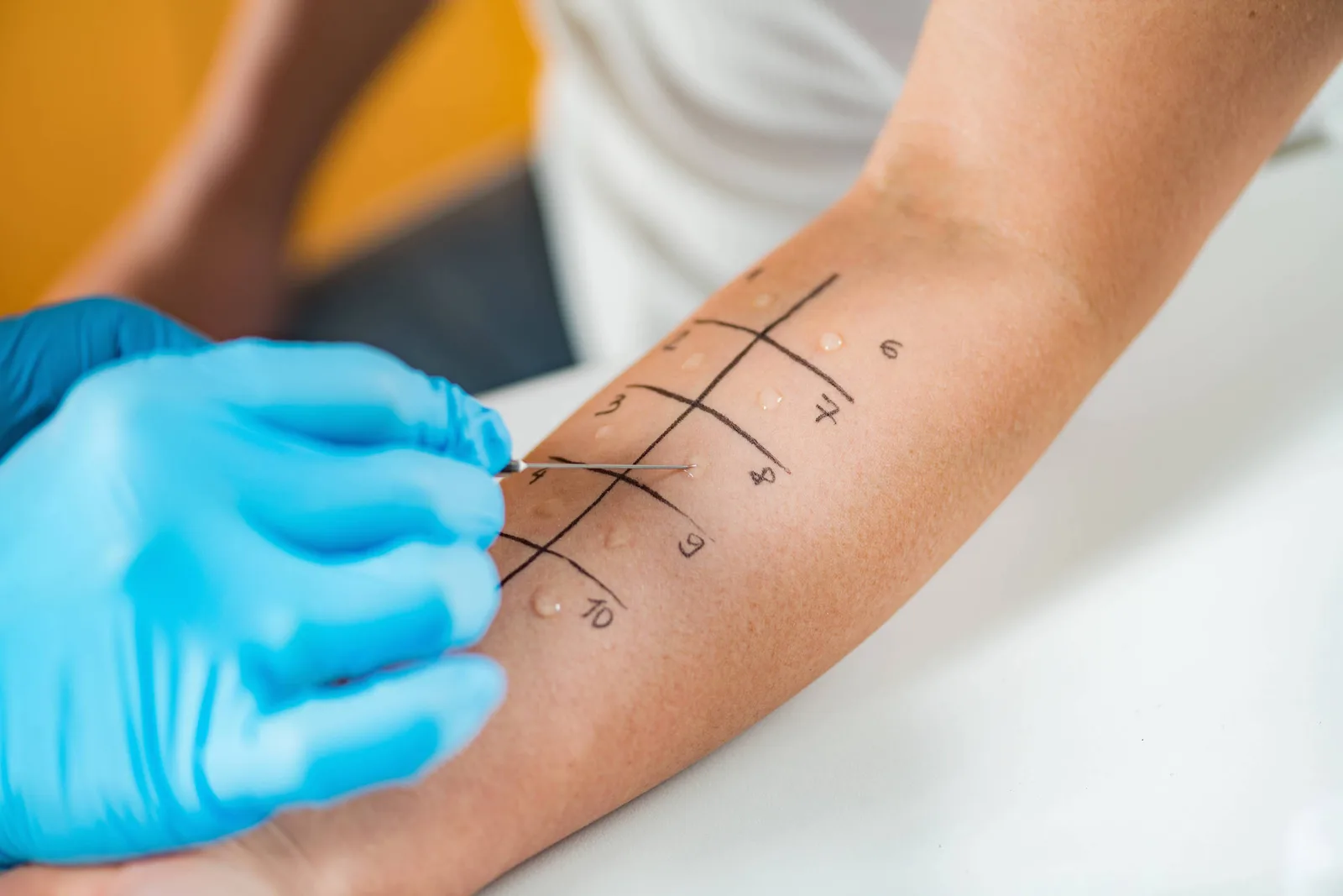 Anafilaxia já matou 40 pessoas no Brasil no primeiro semestre de 2026